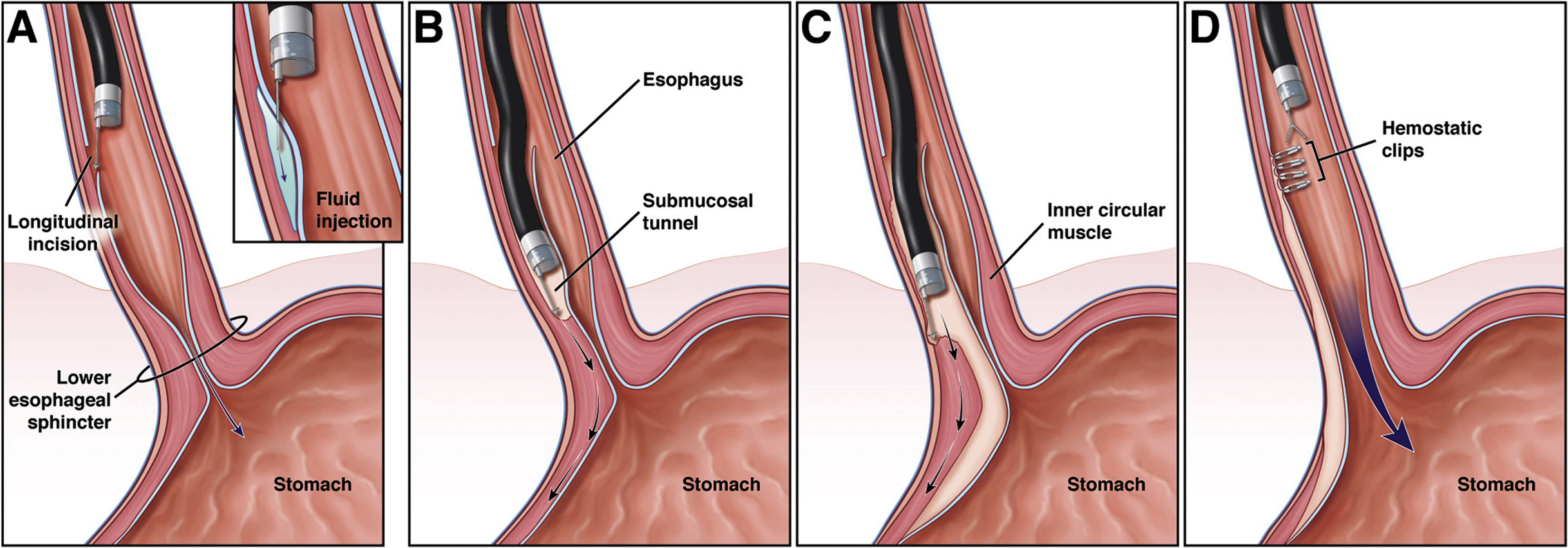 POEM achalasia treatment