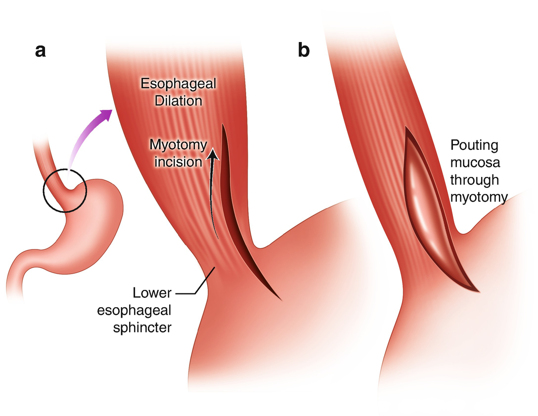 Heller Myotomy