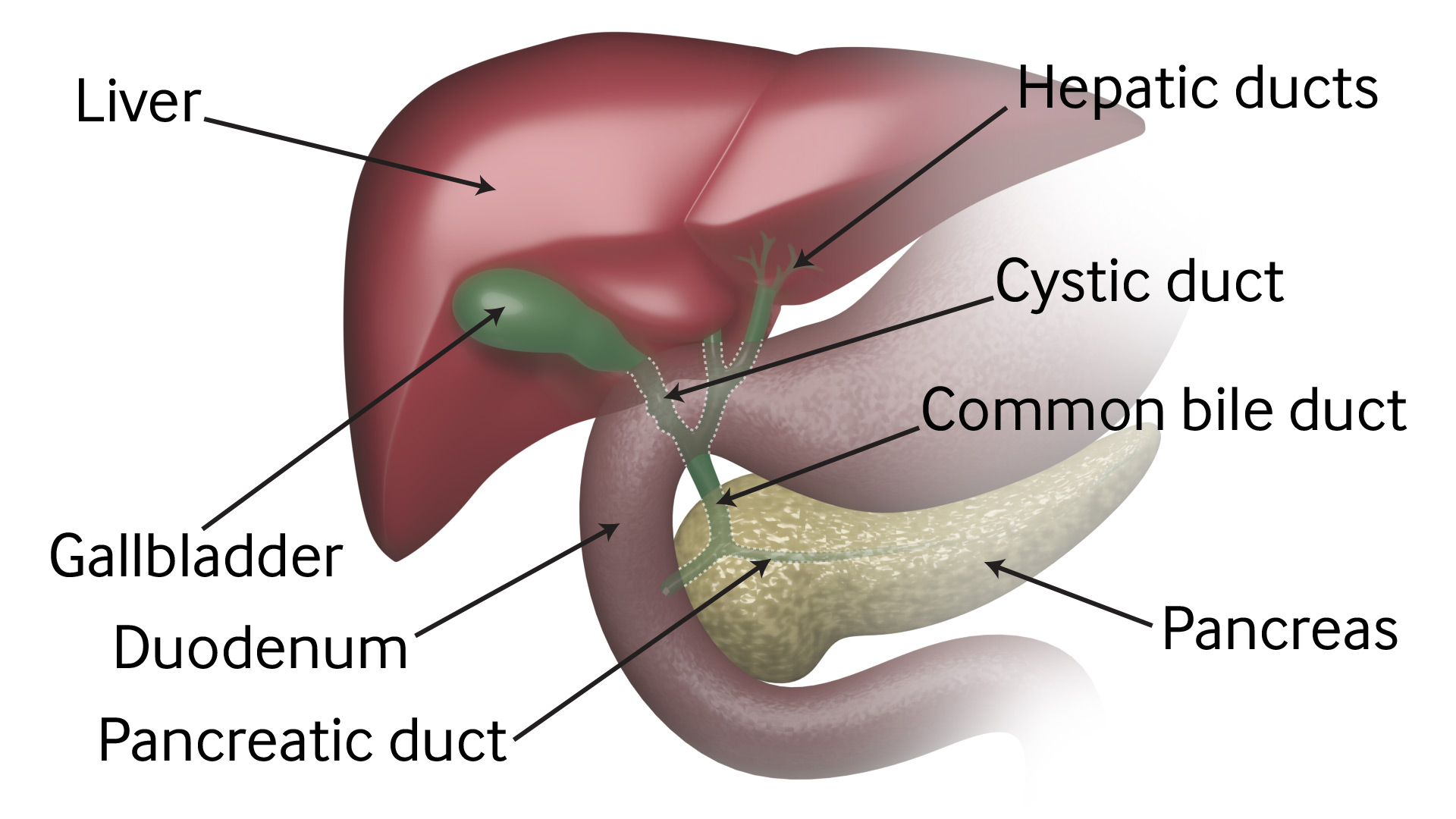 Acute Cholecystitis