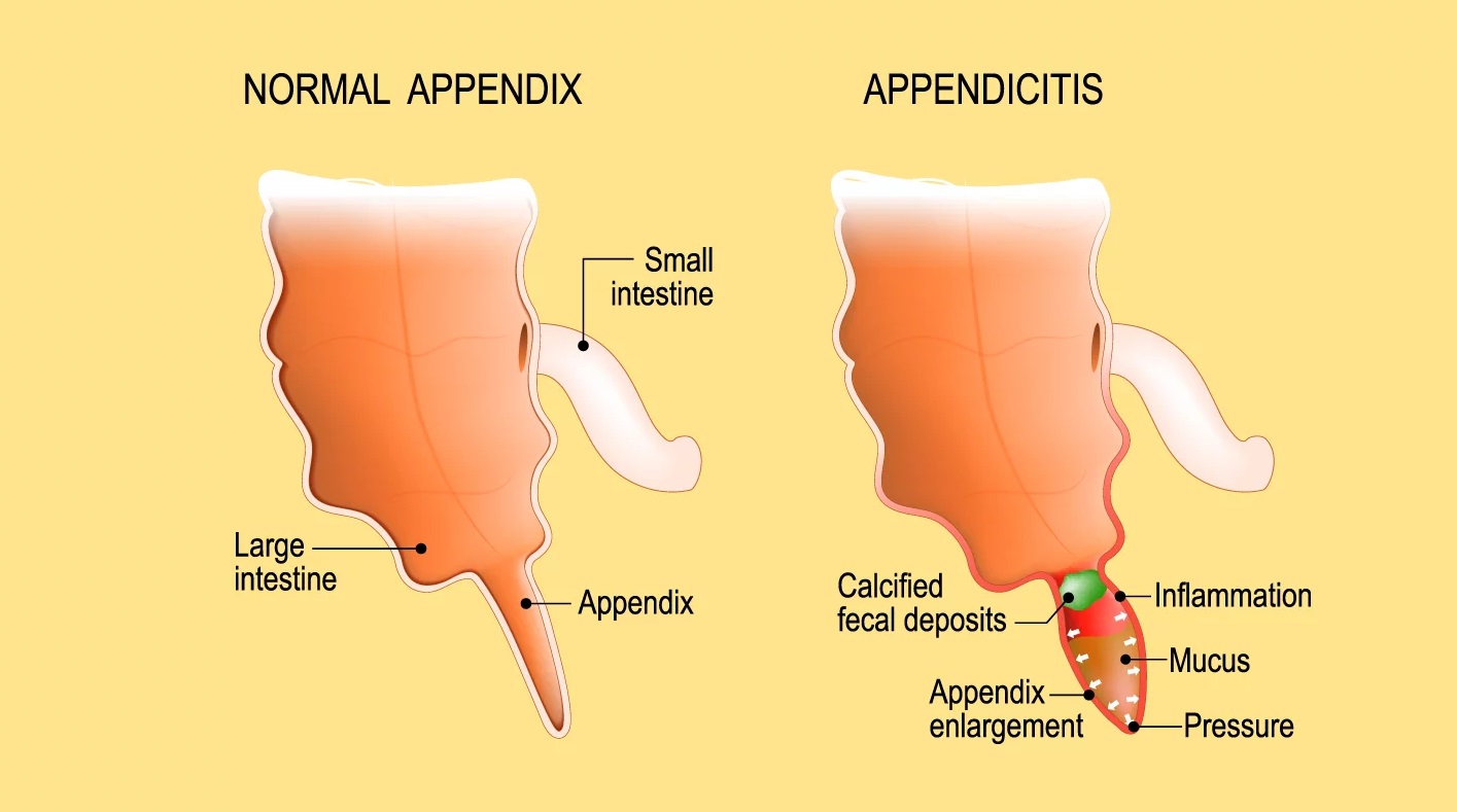 Appendicitis