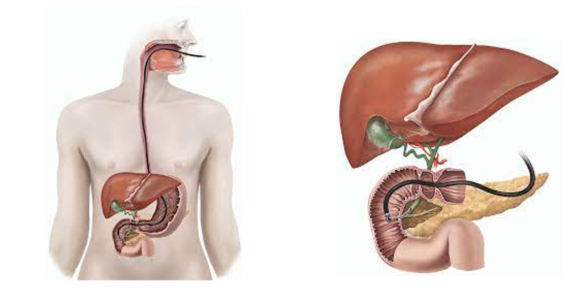 Cholangioscopy- Applications, Limitations, and how it differs from standard ERCP