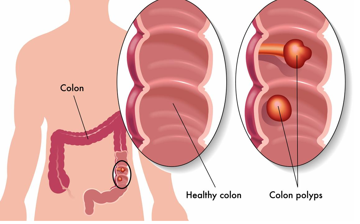 Colon Polyp