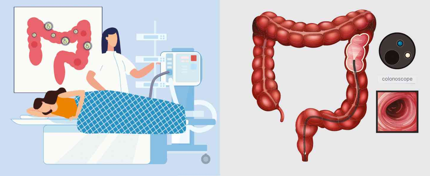 Colonoscopy- Procedure, Preparation and Results