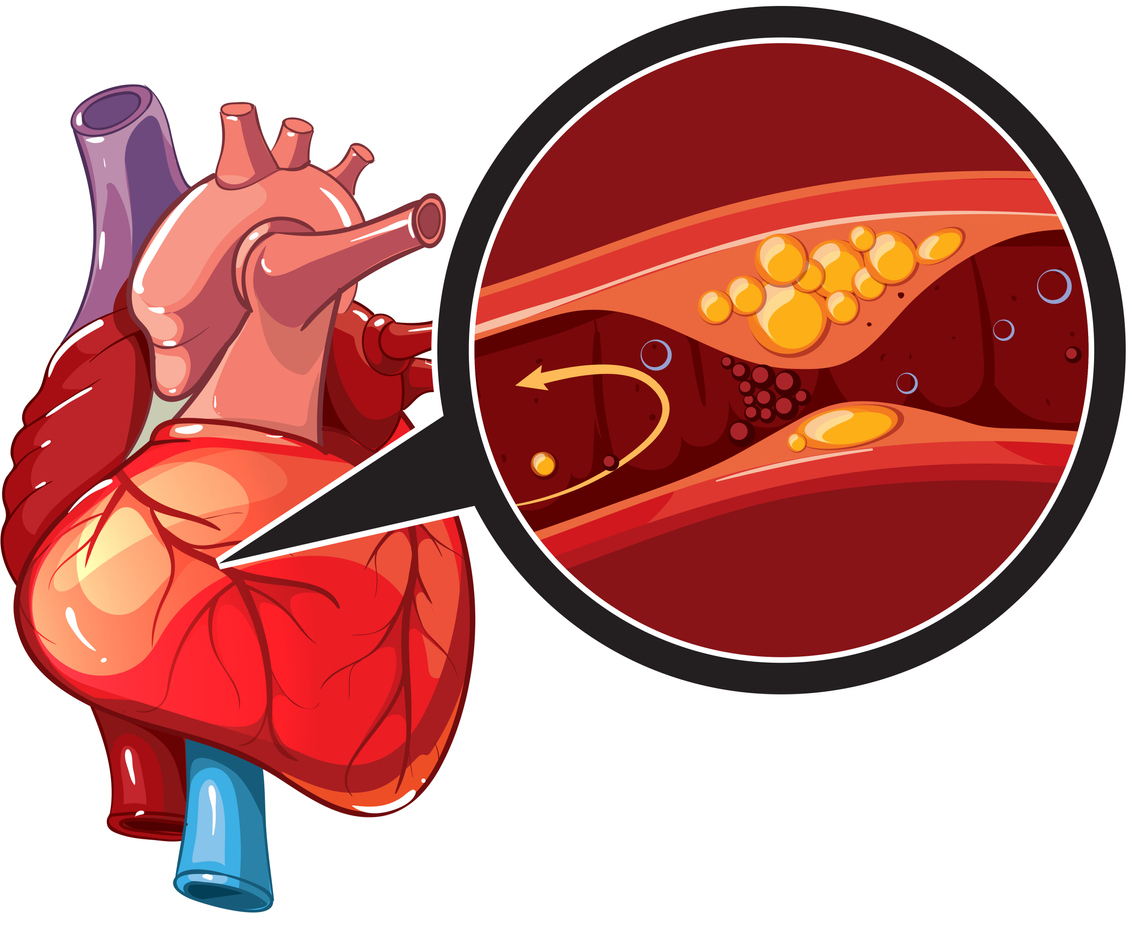 Coronary Artery Disease