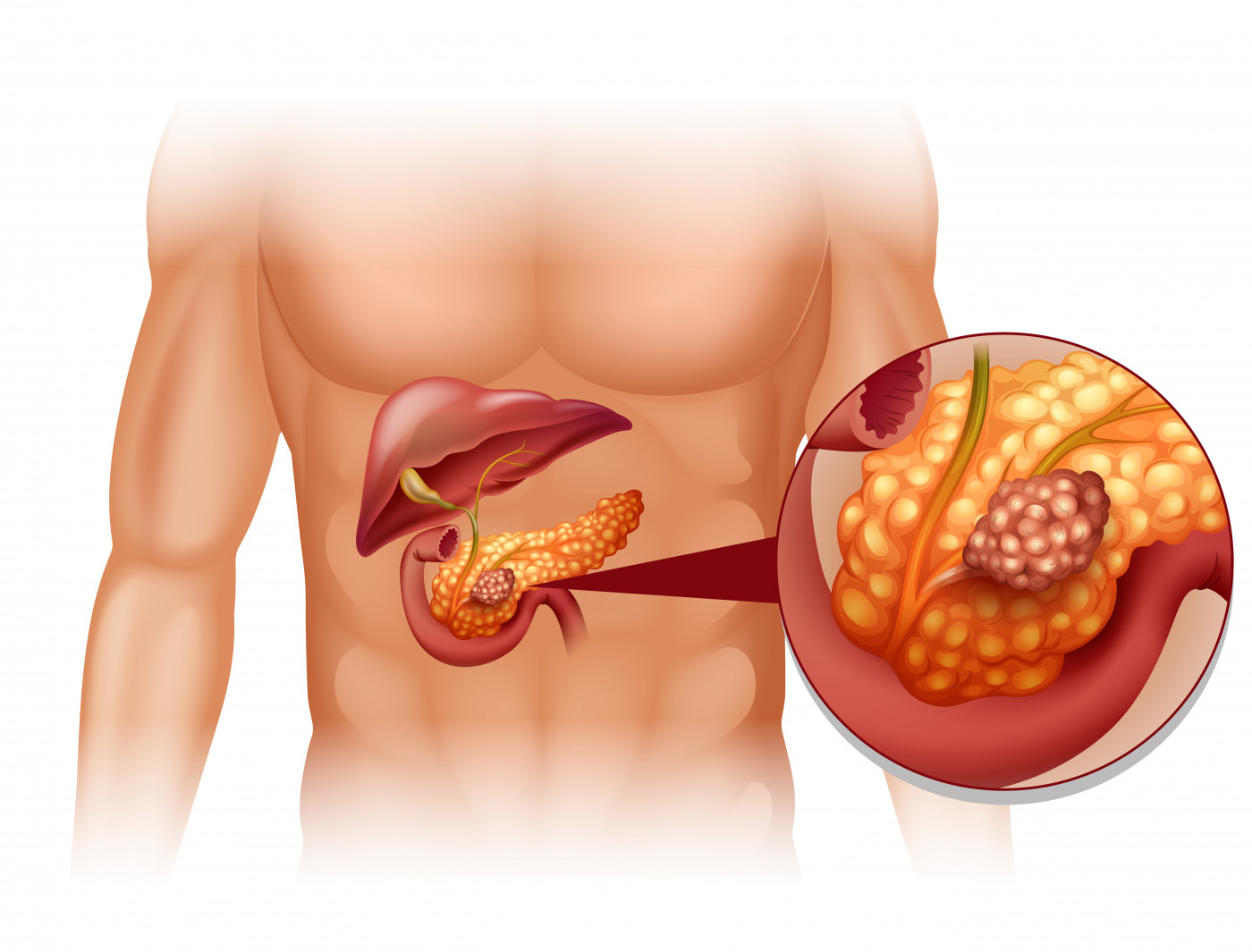 How to check for Exocrine Pancreatic Insufficiency: Lab Tests and Imaging