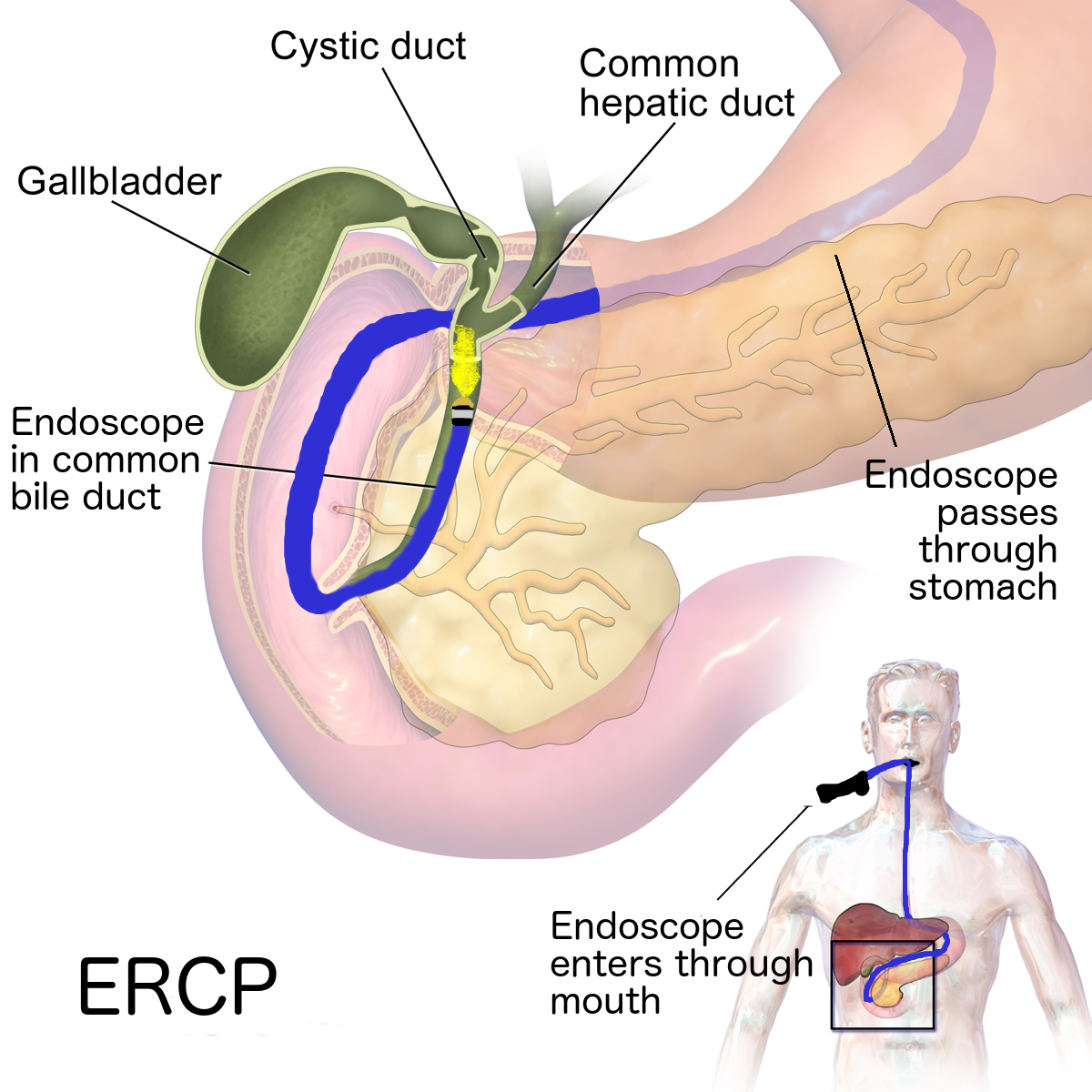Endoscopic Retrograde Cholangiopancreatography (ERCP)- A test for digestive diseases