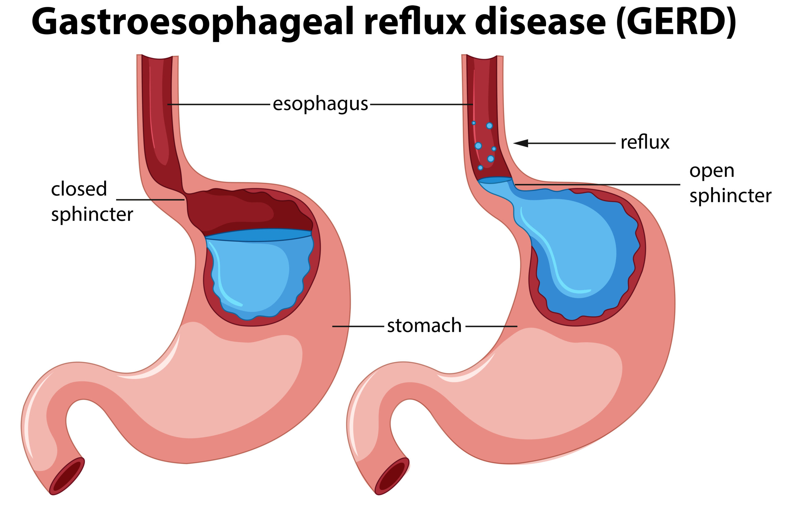 Reflux (GERD) Surgery