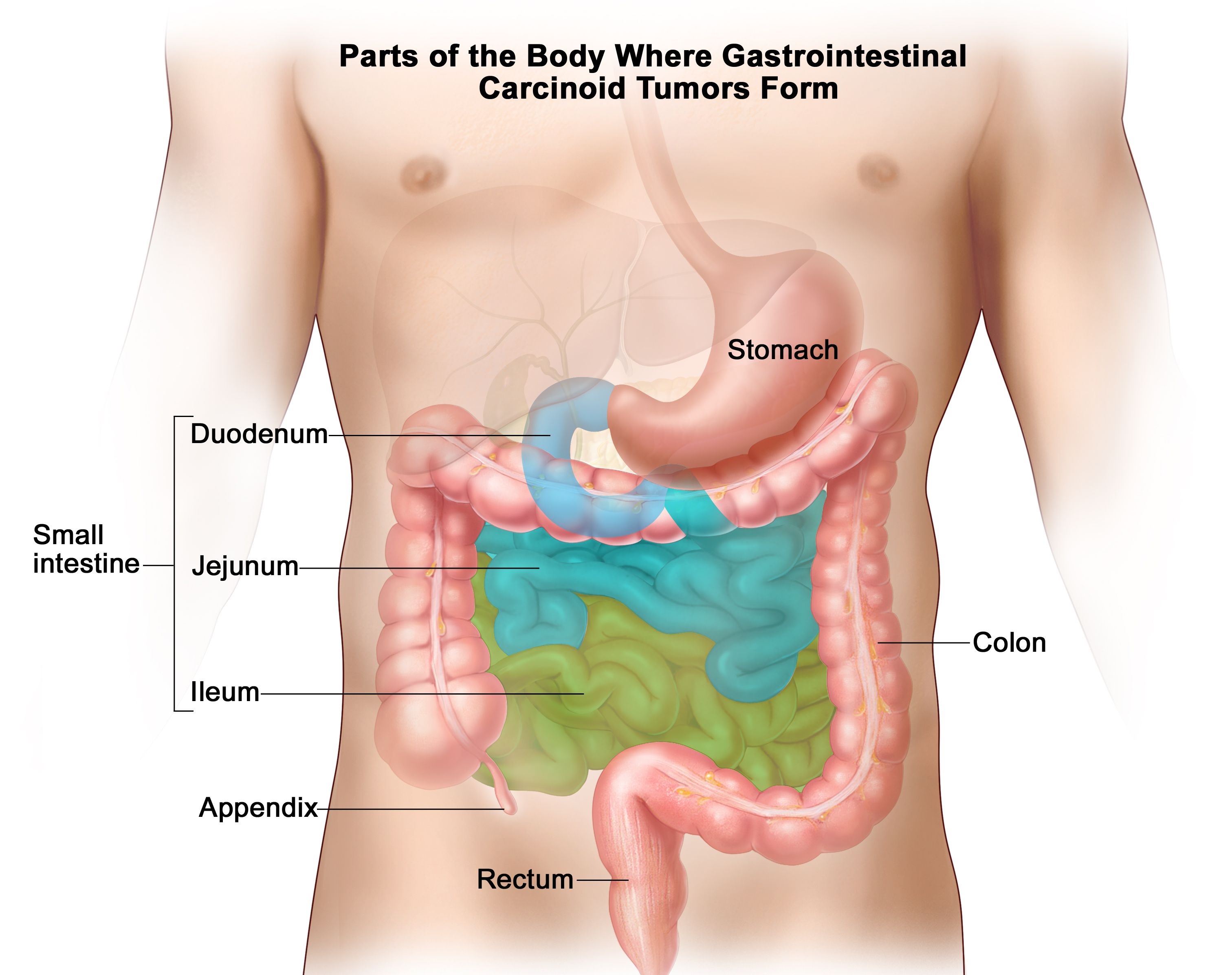 Stomach cancer surgery