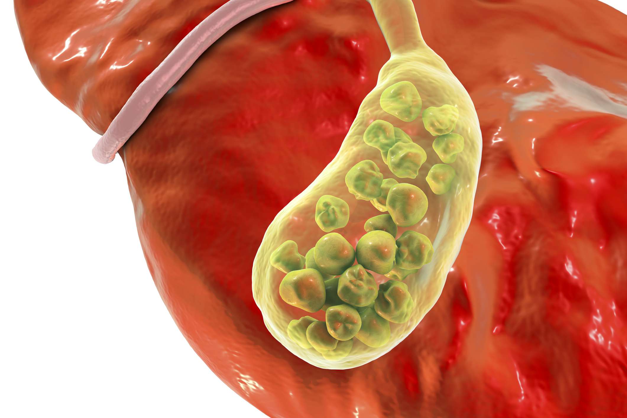 Gall Bladder Stones Gall Stones