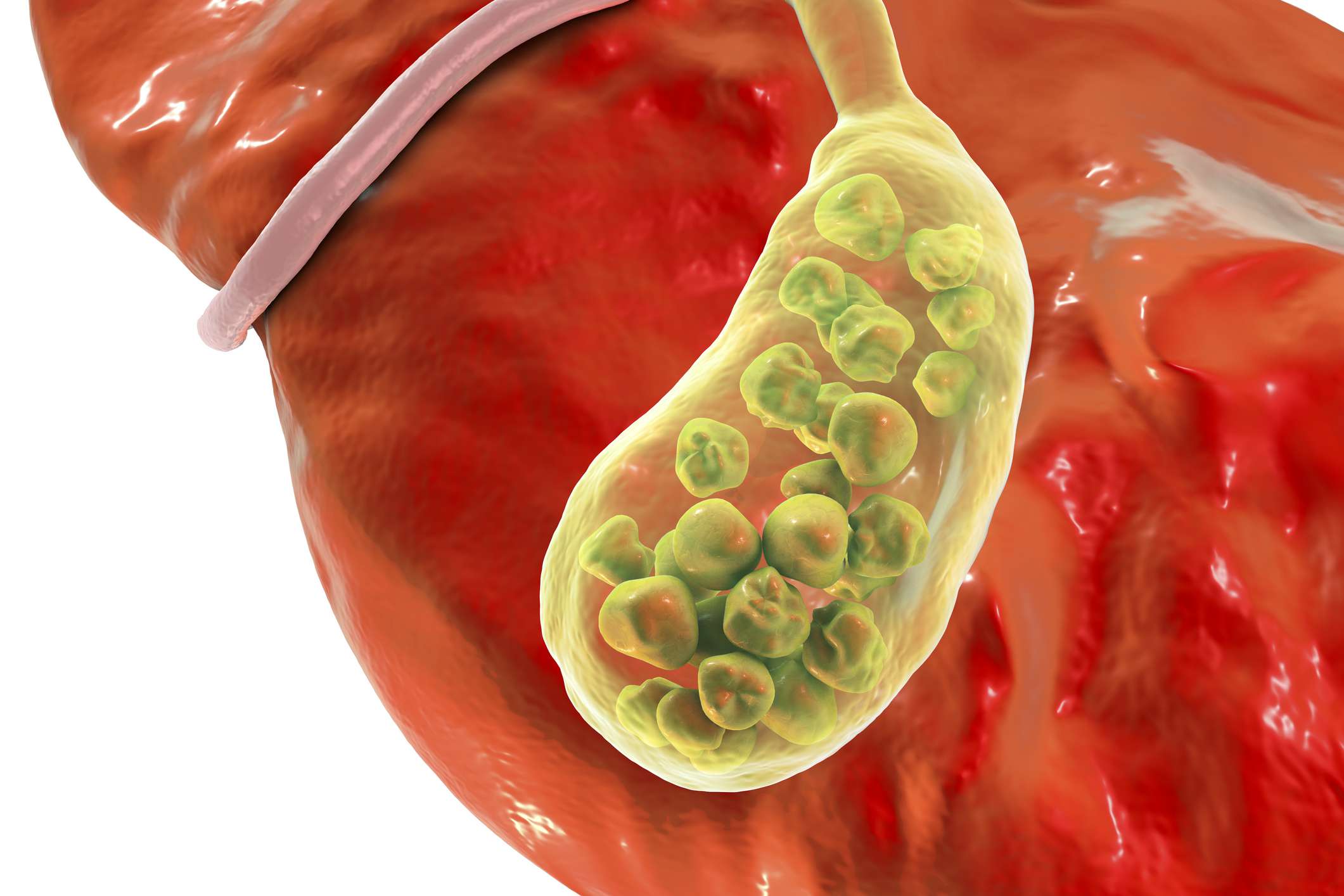 Gall Bladder Stones Gall Stones