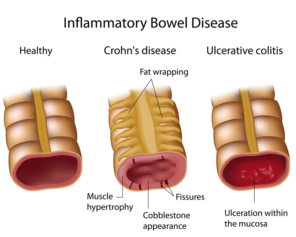 Inflammatory Bowel Disease