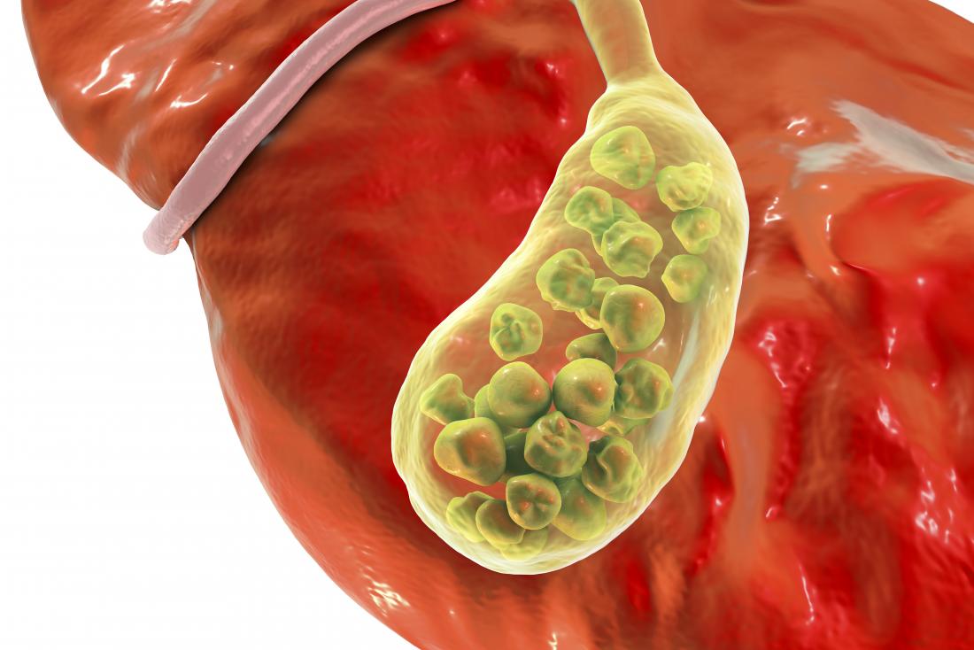 Learn about the latest study on Gallstones risk factors and prevalence in Central India