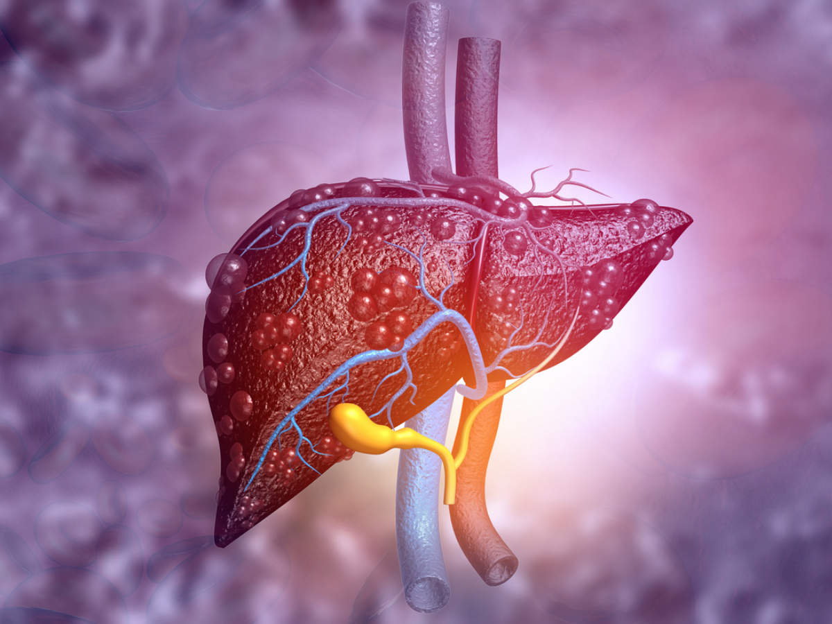 Liver Cirrhosis