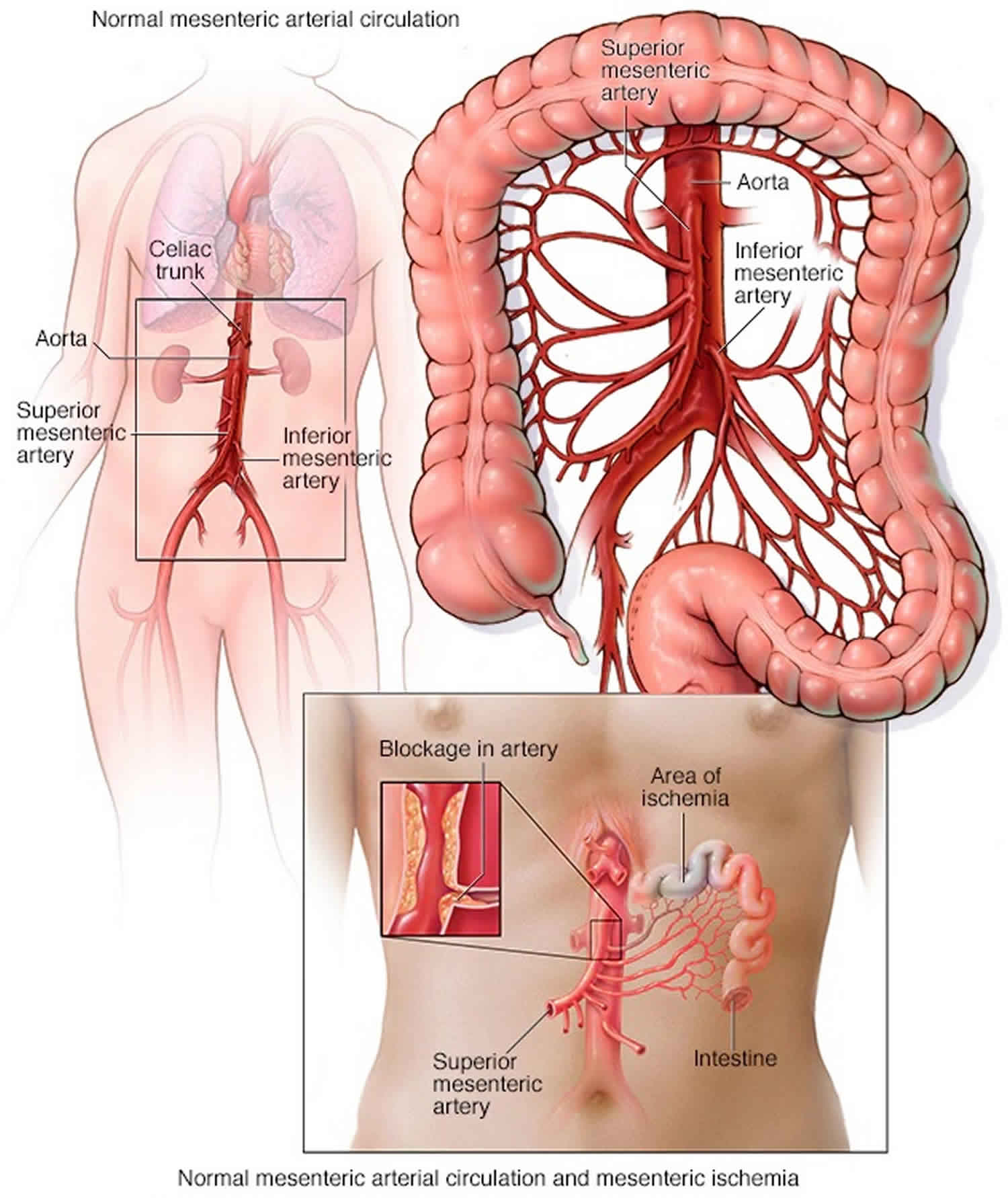 Small Bowel Ischemia/ Ischaemia