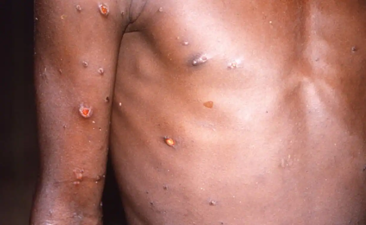 200+ official cases of Monkeypox recorded worldwide- India is prepared, no cases in country yet, says The Indian Council of Medical Research (ICMR)