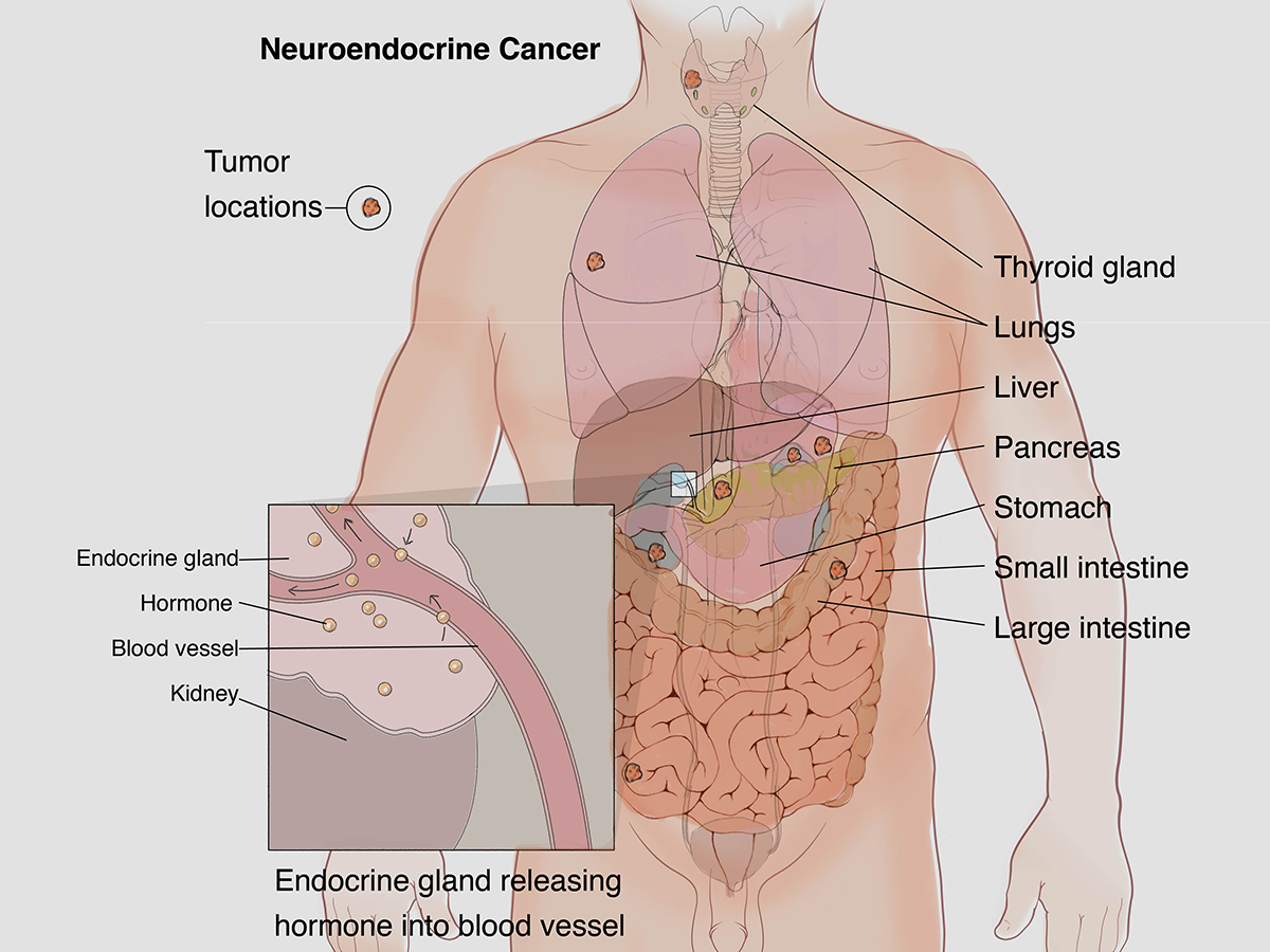 Neuroendocrine Tumors (NET's)- What it is, What are its Risk Factors, Causes, Treatment and more