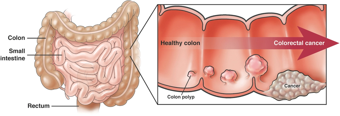 Locally Advanced Colorectal Cancer