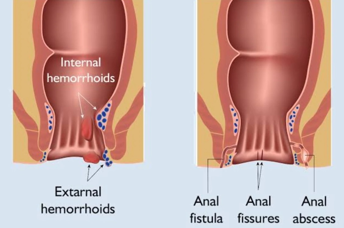 Piles Surgery