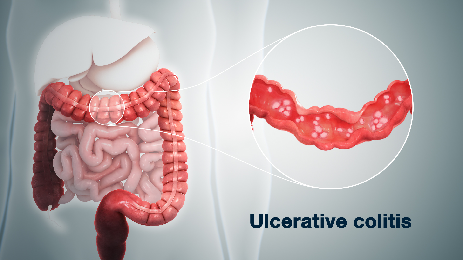 Ulcerative Colitis Best Gastro Surgeon Ahmedabad, Best