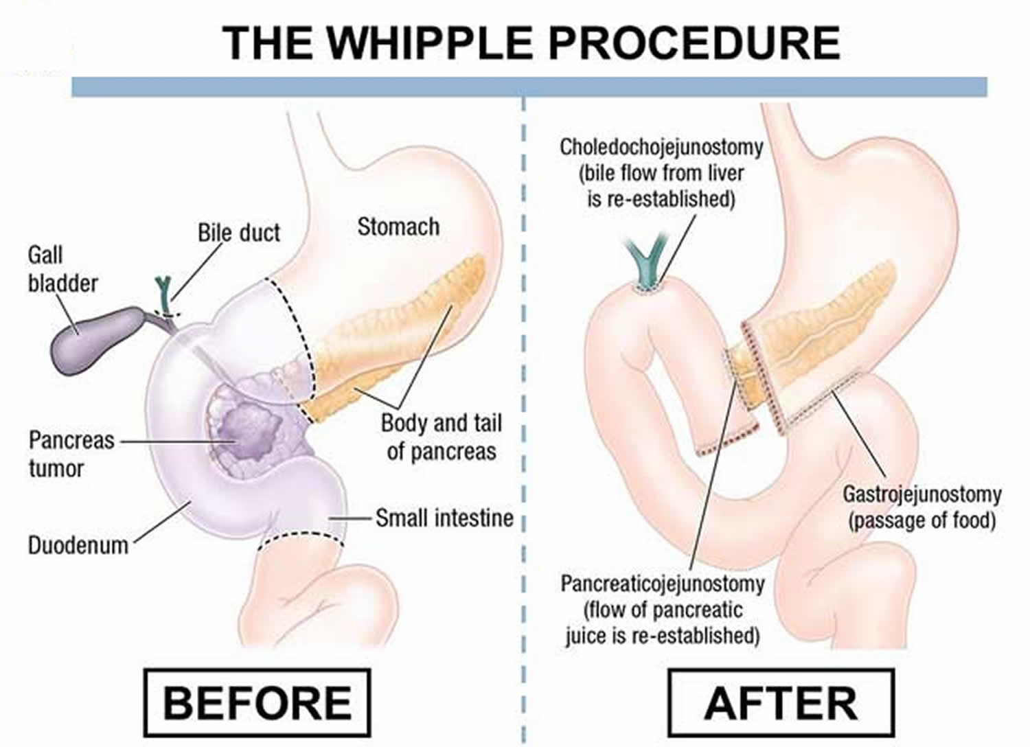 Whipple Procedure- What is it? When it is done? Which organs are removed? Complications & Post Surgery Care