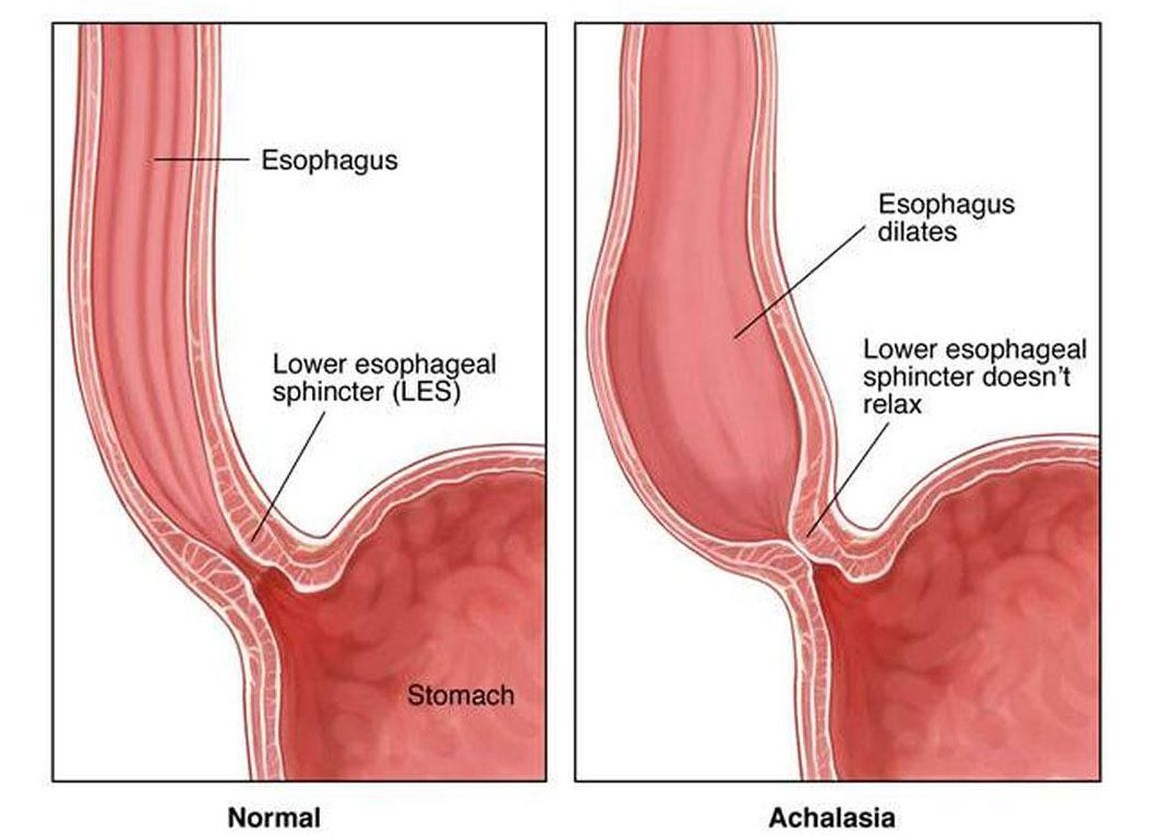 Achalasia