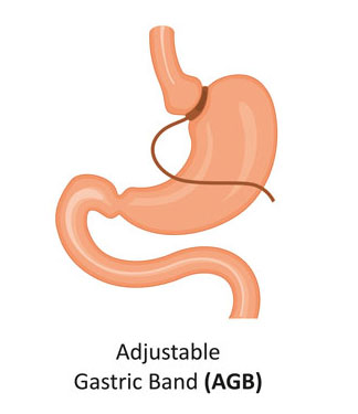 Adjustable Gastric Surgery at Obesity Doctor