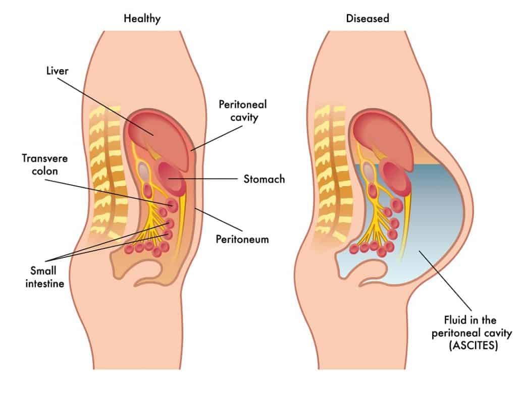 Ascites