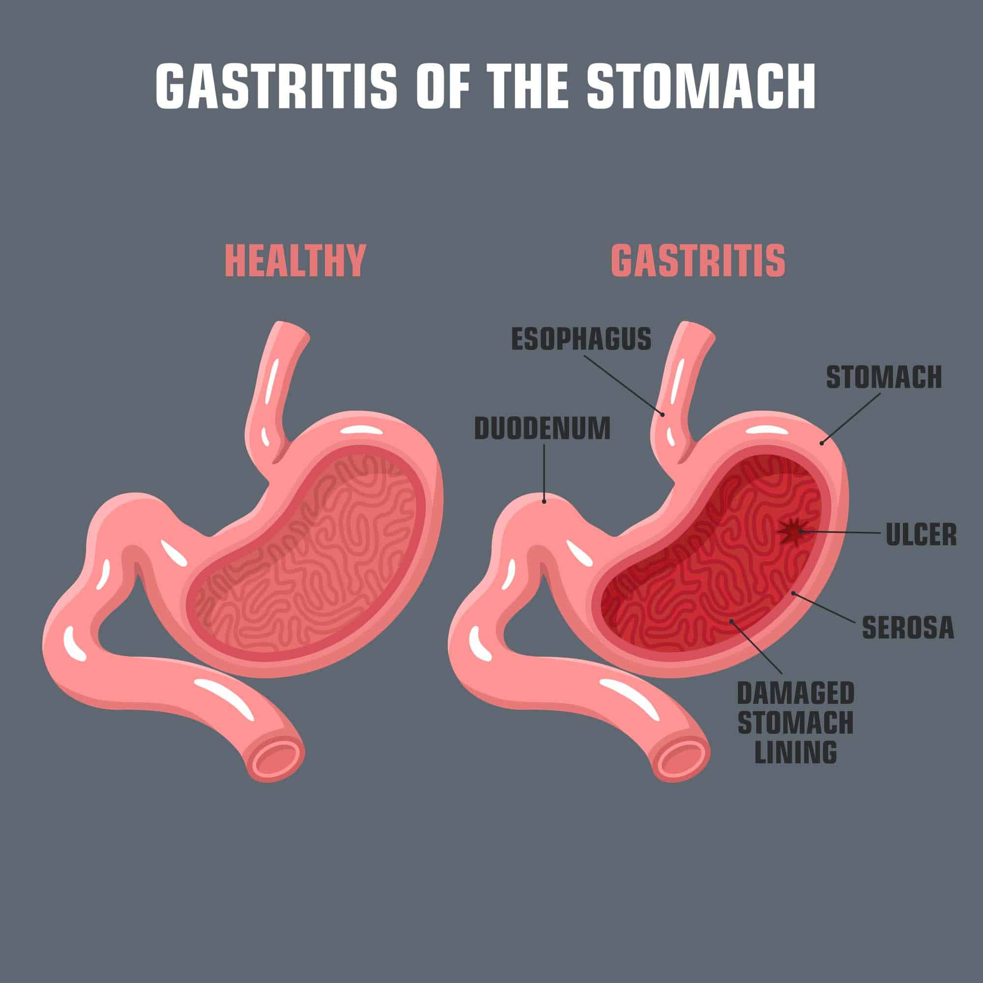 Gastritis