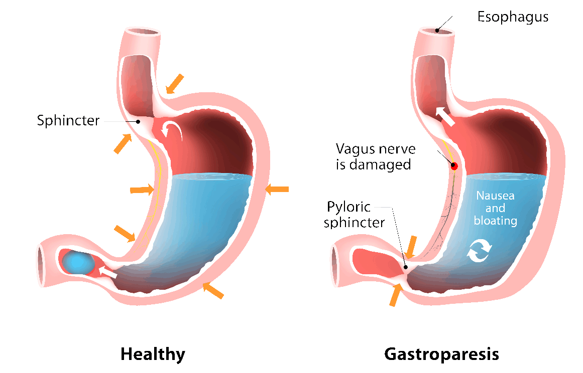 Gastroparesis