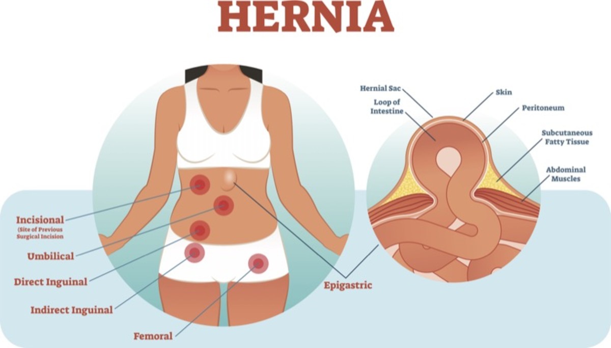 Hernia Surgery