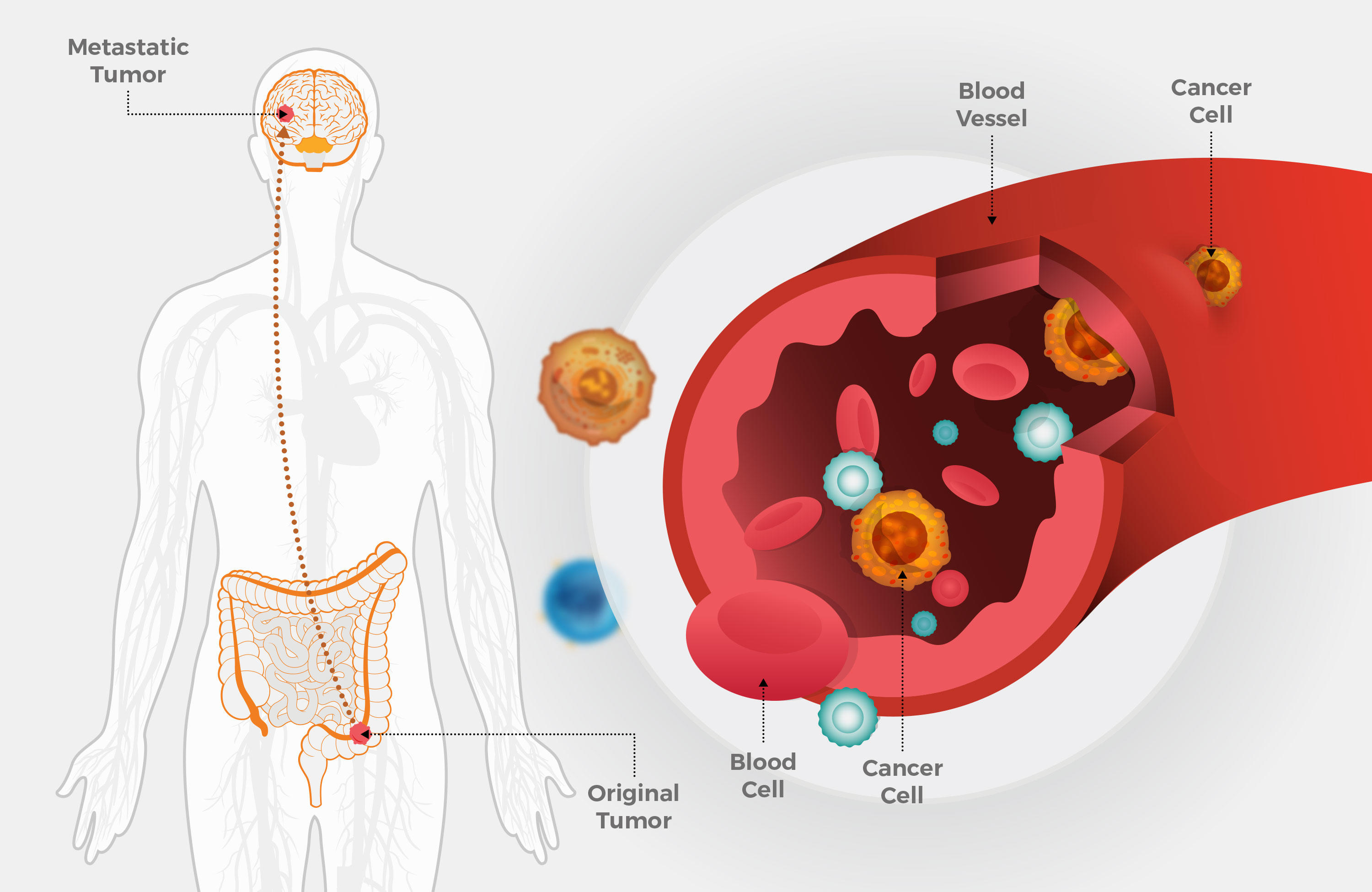 Locally Advanced Colorectal Cancer