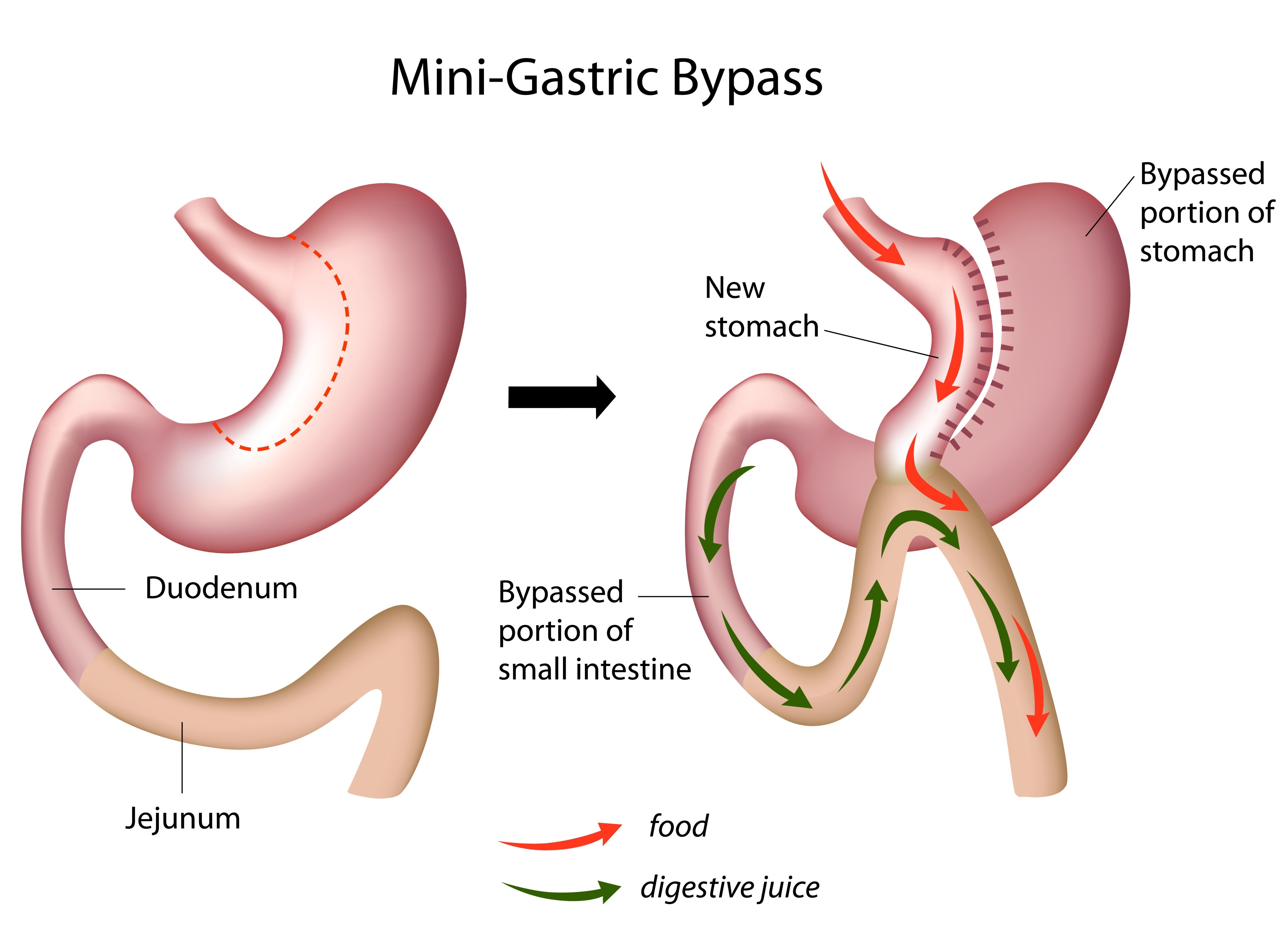 Mini Gastric Bypass Surgery