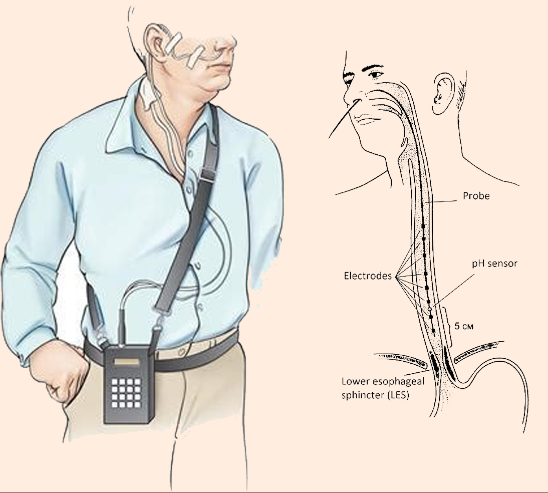 Esophageal pH monitoring