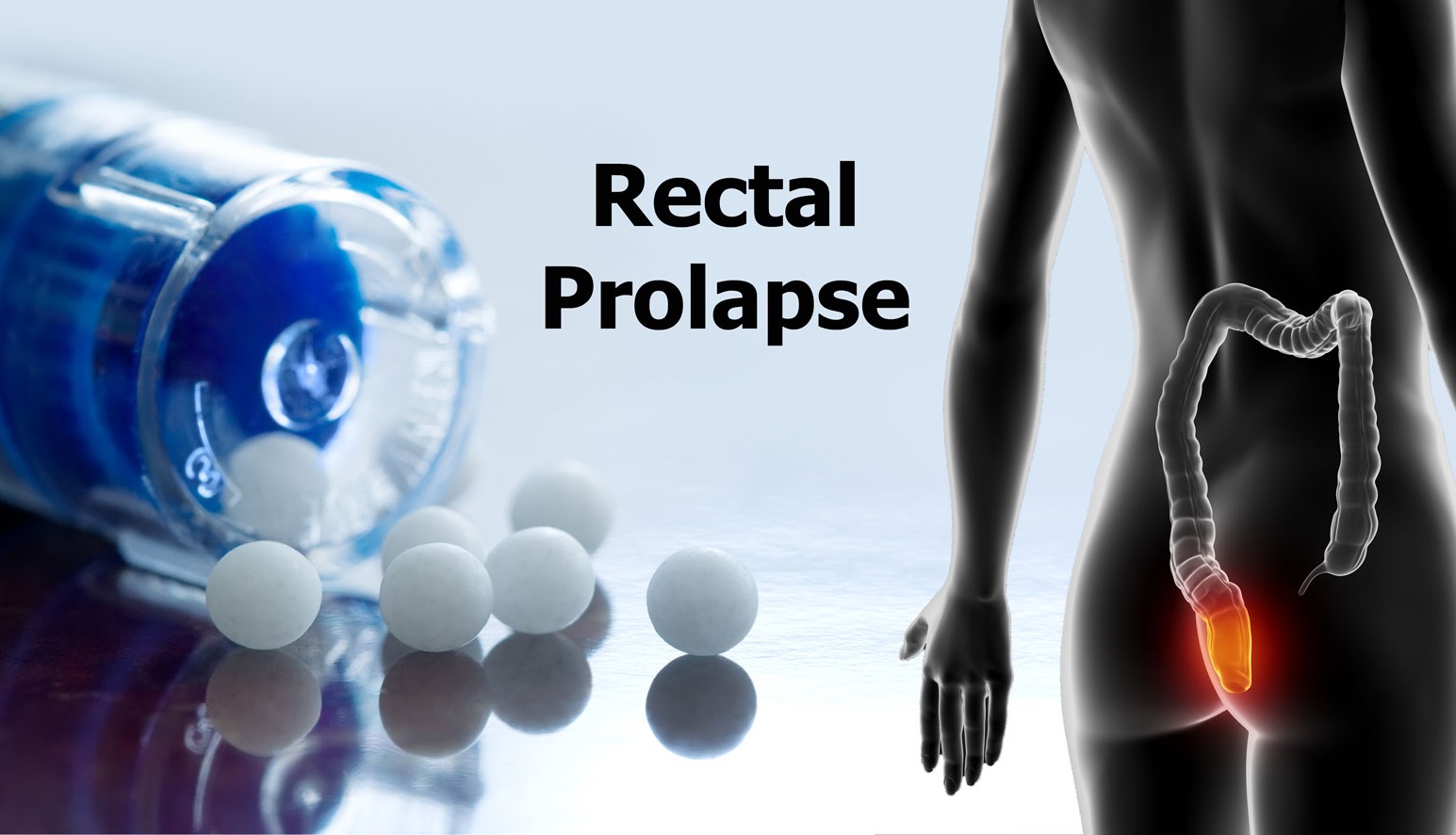 Rectal Prolapse