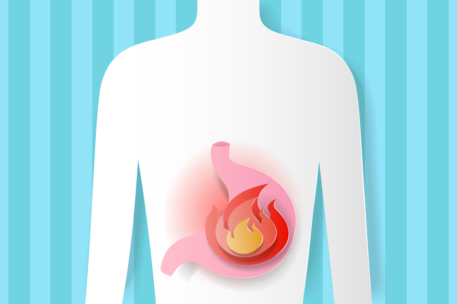 Reflux/ Heartburn