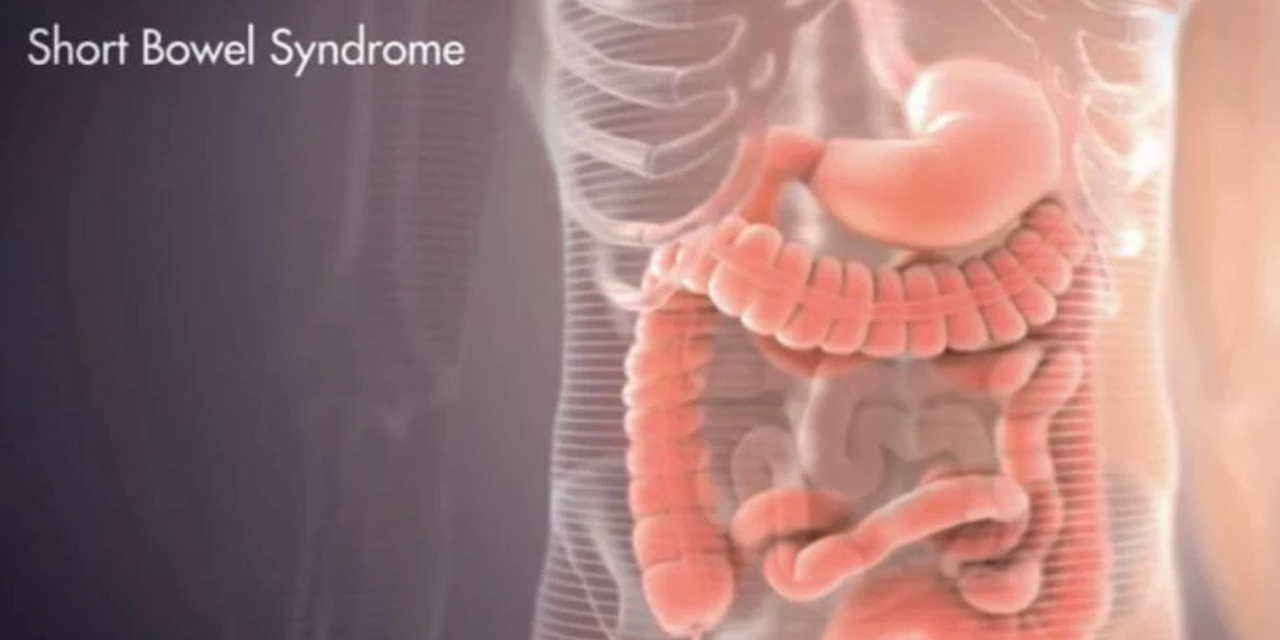 Short Bowel Syndrome