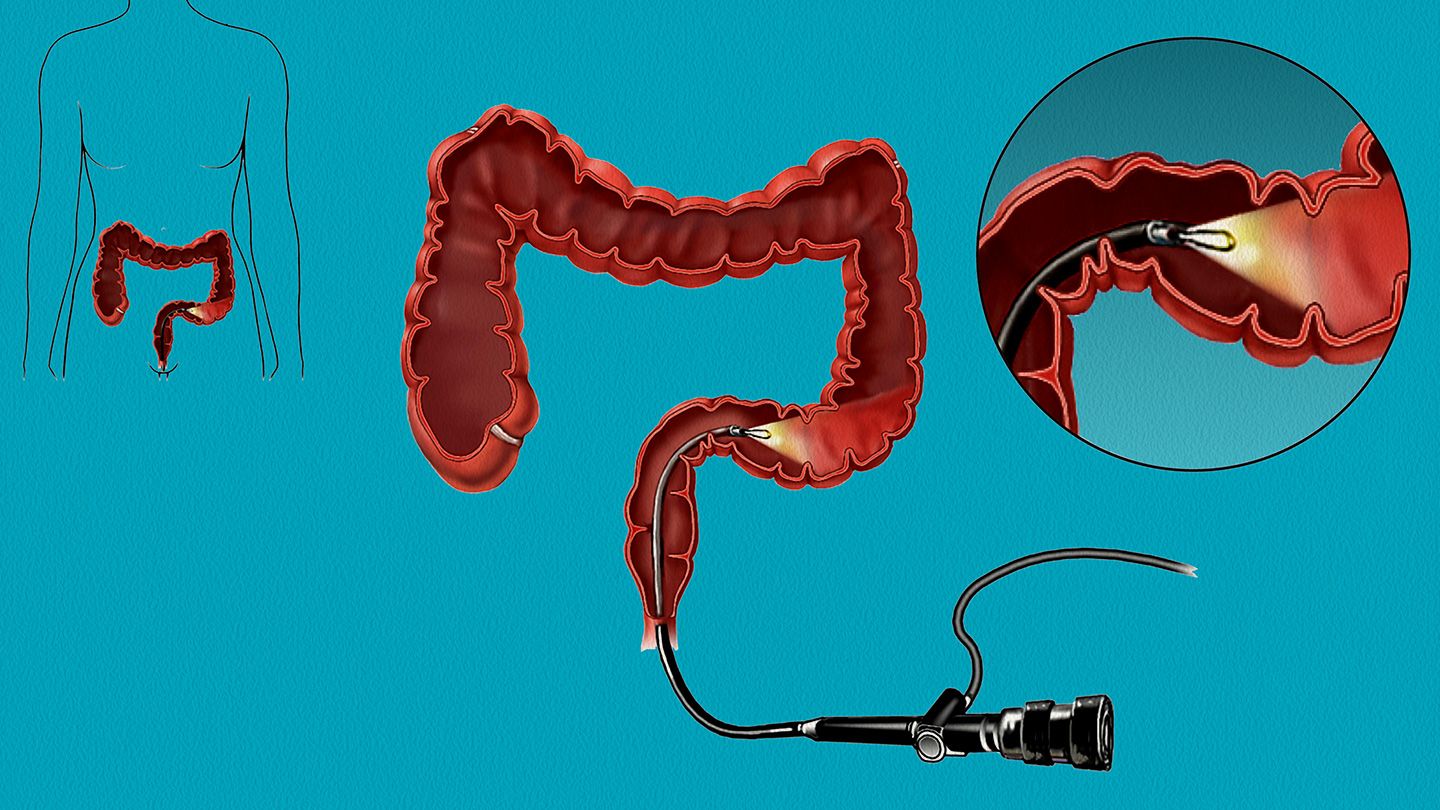 Sigmoidoscopy- Procedure, Risks and Results