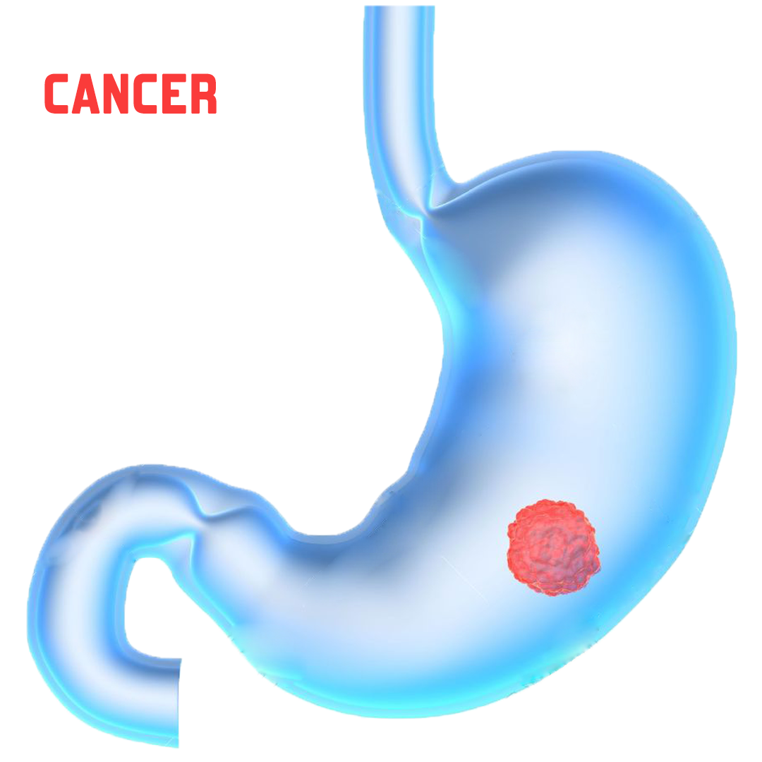 Stomach cancer screening for self and family
