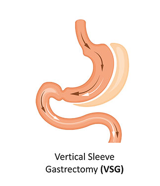 Gastric Sleeve Surgery