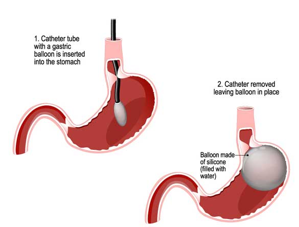 Gastric Balloon Procedure for weight loss surgery